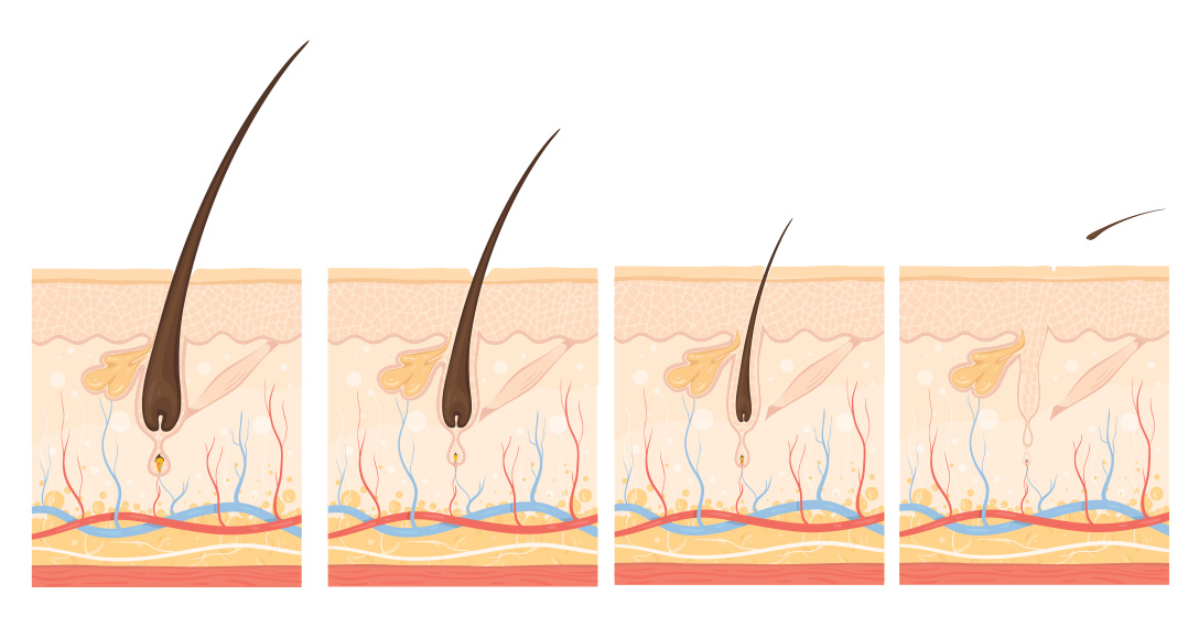 Proces łysienia androgenowego i zaniku mieszka włosowego włosa